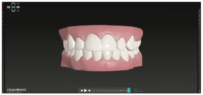 Digital Workflows for Adult Orthodontic-Restorative Treatment